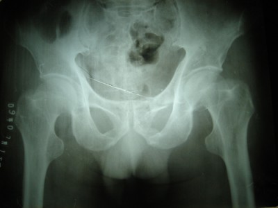 老年股骨股胫骨折病例